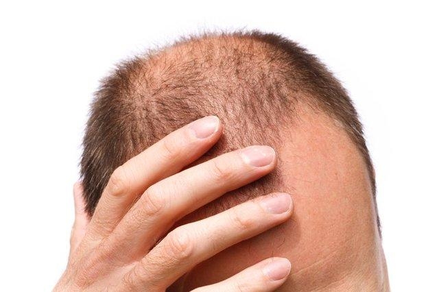 Saç dökülmesinin 20 nedeni 8