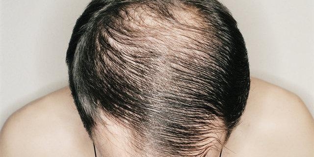Saç dökülmesinin 20 nedeni 9