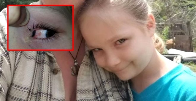 Acı içerisinde uyanan 6 yaşındaki kızın gözünden bezelye tanesi büyüklüğ 2
