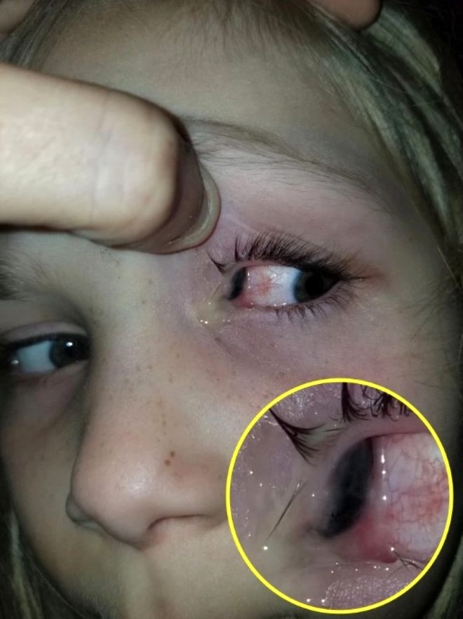 Acı içerisinde uyanan 6 yaşındaki kızın gözünden bezelye tanesi büyüklüğ 7