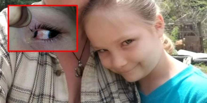 Acı içerisinde uyanan 6 yaşındaki kızın gözünden bezelye tanesi büyüklüğ