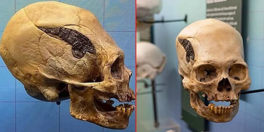 Akılalmaz keşif! Dünyanın en eski kafatası ameliyatı böyle yapılmış