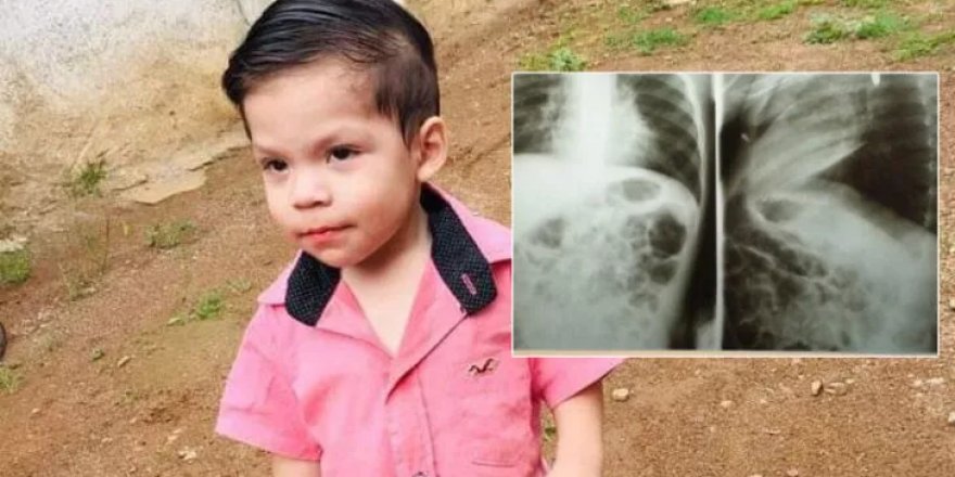Yuttuğu pil içinde patladı! 2 yaşındaki ufaklık şimdi yaşam savaşı veriyor