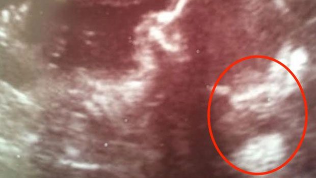 Bebeğinin ultrasonuna bakınca öyle birşey fark etti ki...