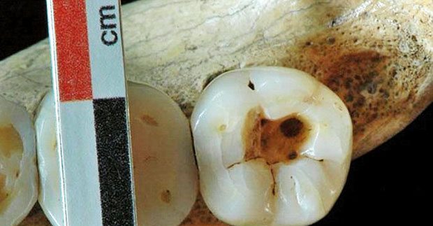 14 bin yıl önce dişçiye gitmiş