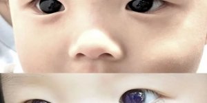 Covid ilacı verilen bebeğin göz rengi bir gecede değişti